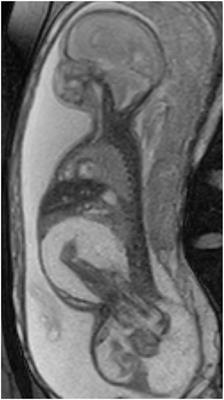 Case Report: The Medical and Surgical Management of an Infant With Extreme Prematurity and Fetus-In-Fetu